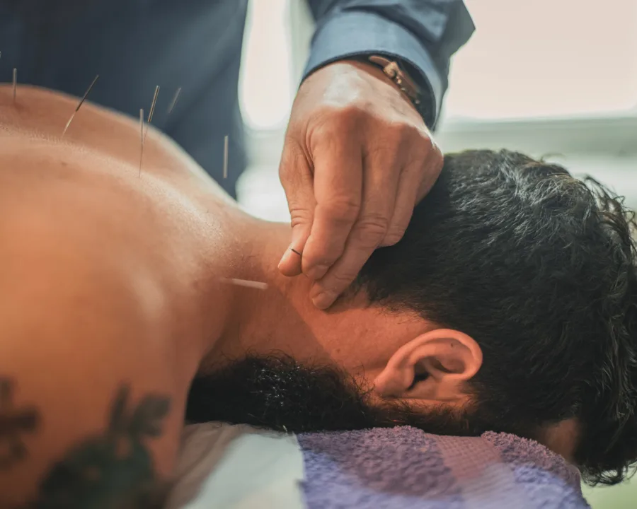 Dry needling